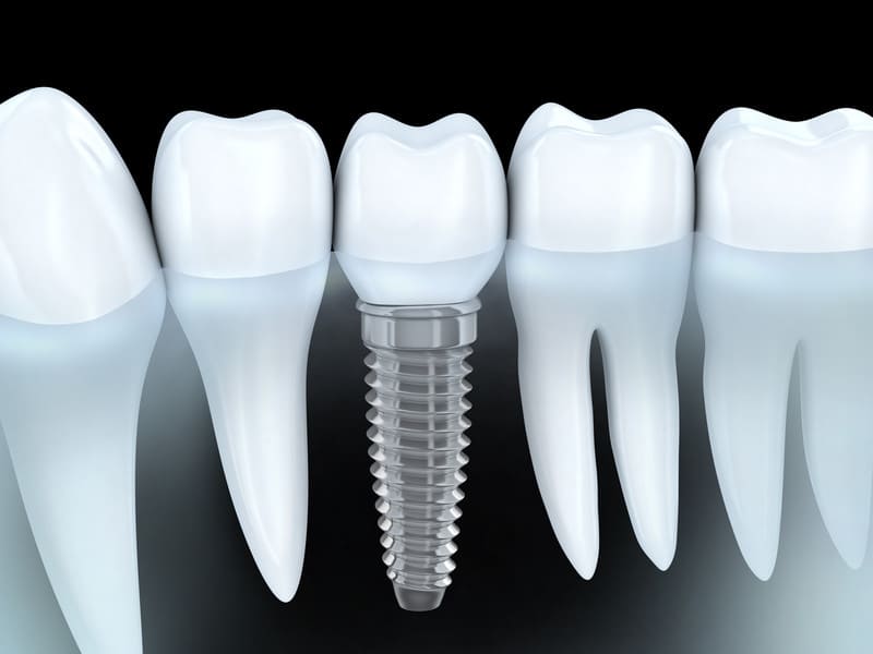 DOCS Dental Dental Implants
