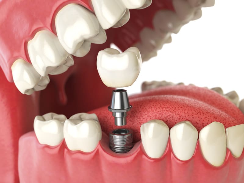 DOCS Dental all-on-4 dental implants